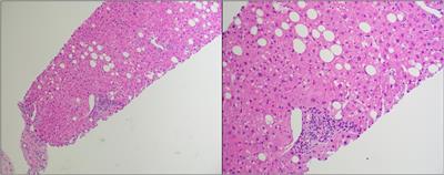 Case report: Pulse cyclophosphamide for treatment of multi-agent-refractory hepatic graft-versus-host disease